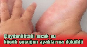 AYAK TOPUKLARINDA YANIK OLUŞTU