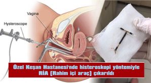 HİSTEROSKOPİ YÖNTEMİYLE RİA (RAHİM İÇİ ARAÇ) ÇIKARILDI